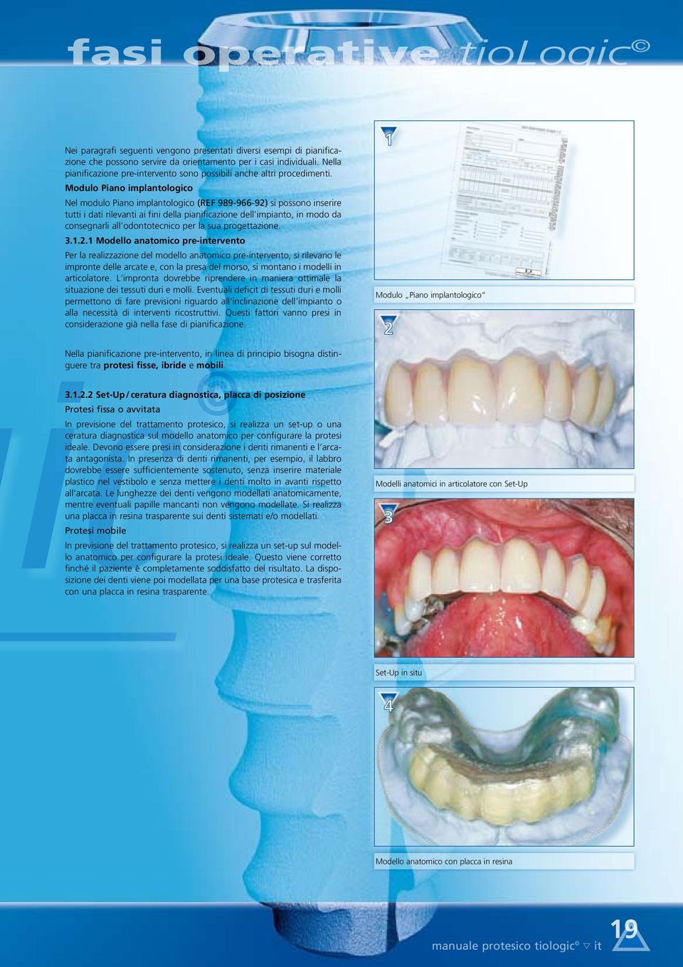 Modulo Piano implantologico Nel modulo Piano implantologico (REF 989-966-92) si possono inserire tutti i dati rilevanti ai fini della pianificazione dell impianto, in modo da consegnarli all