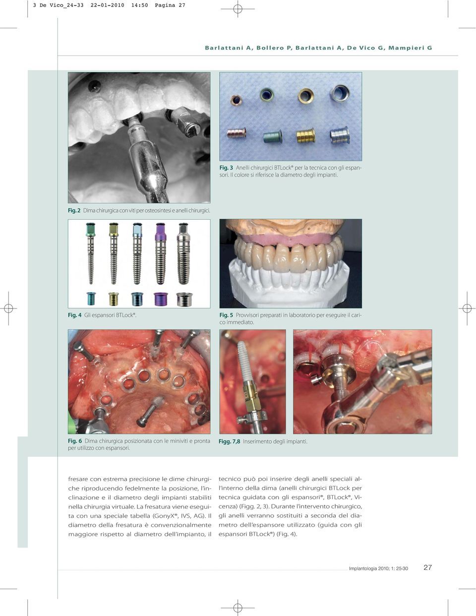 Fig. 5 Provvisori preparati in laboratorio per eseguire il carico immediato. Fig. 6 Dima chirurgica posizionata con le miniviti e pronta per utilizzo con espansori. Figg.