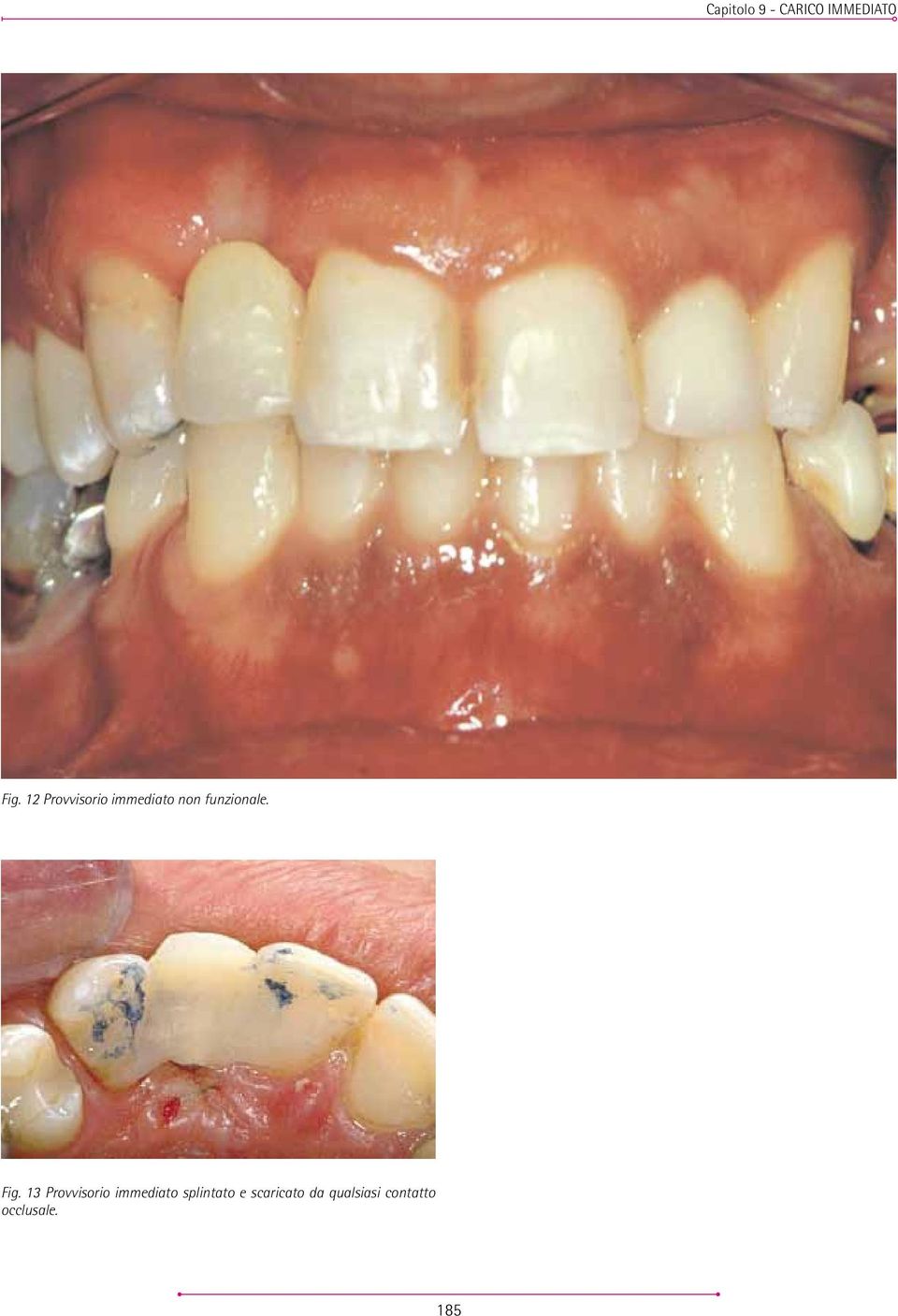 Fig. 13 Provvisorio immediato splintato