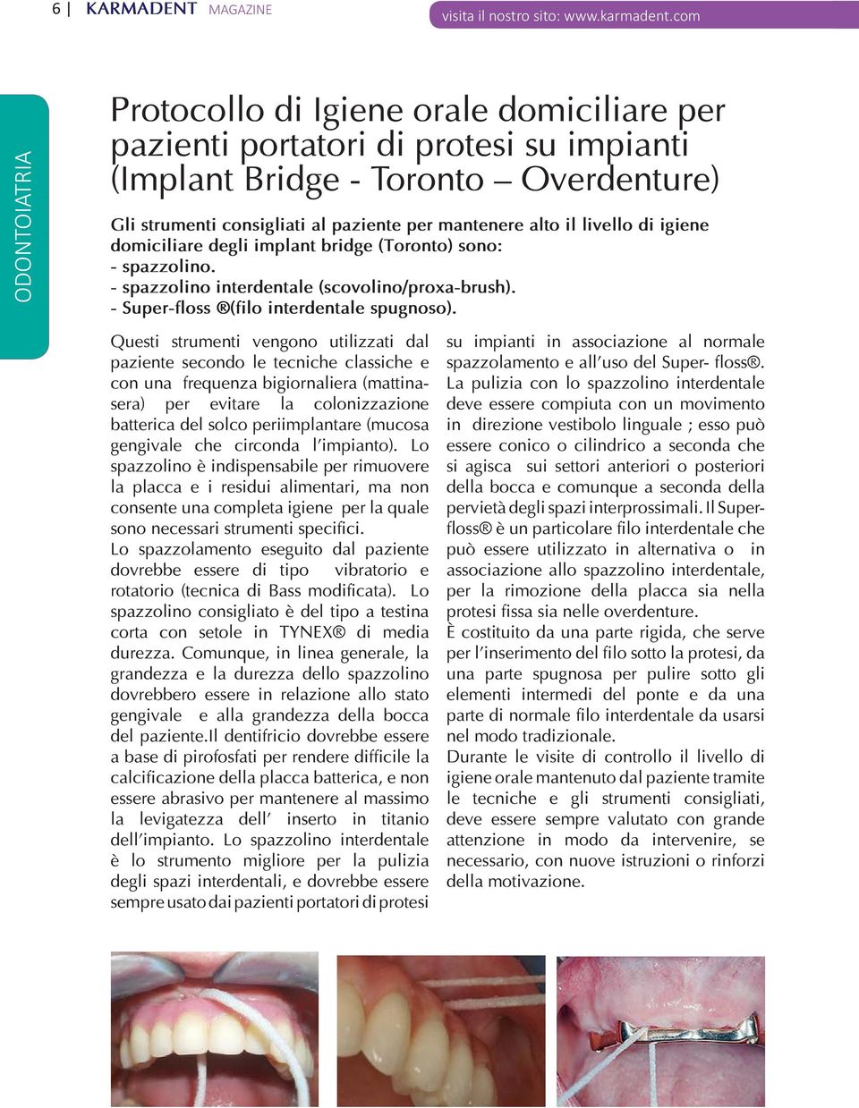 Questi strumenti vengono utilizzati dal paziente secondo le tecniche classiche e con una frequenza bigiornaliera (mattinasera) per evitare la colonizzazione batterica del solco periimplantare (mucosa