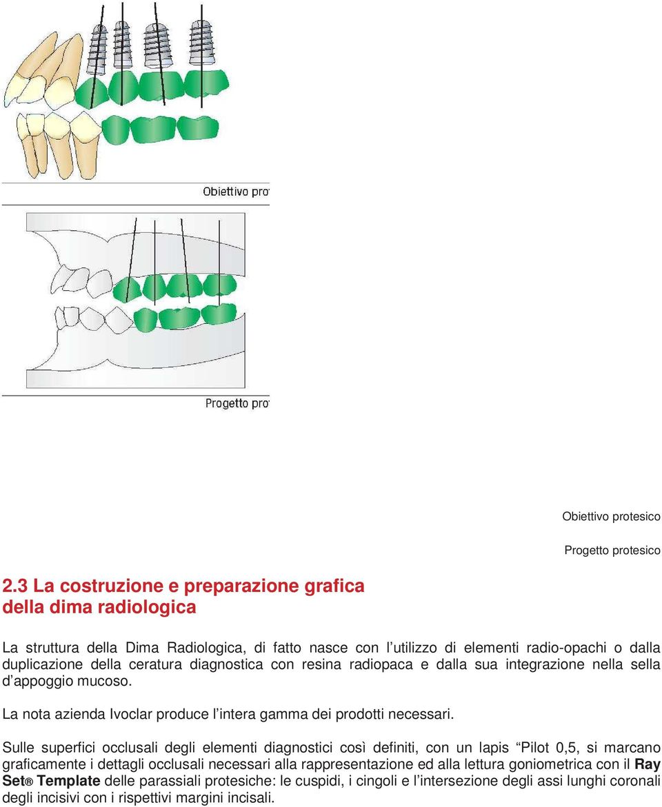 ceratura diagnostica con resina radiopaca e dalla sua integrazione nella sella d appoggio mucoso. La nota azienda Ivoclar produce l intera gamma dei prodotti necessari.