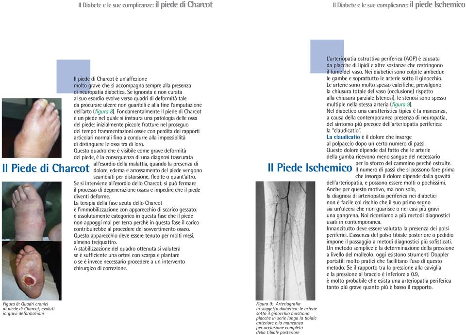 Fondamentalmente il piede di Charcot è un piede nel quale si instaura una patologia delle ossa del piede: inizialmente piccole fratture nel proseguo del tempo frammentazioni ossee con perdita dei