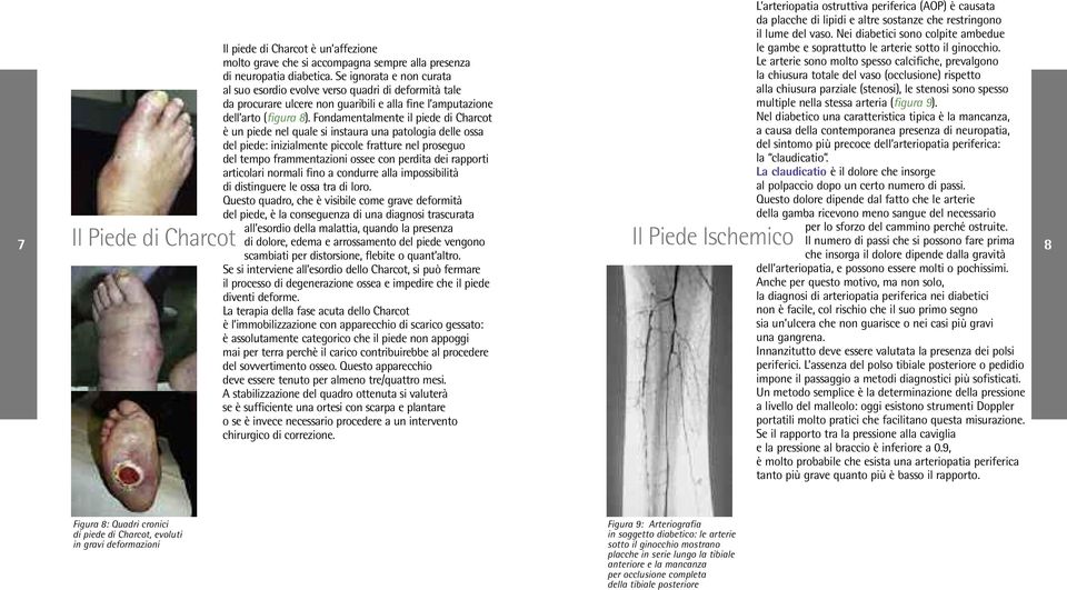 molto grave che si accompagna sempre alla presenza Le arterie sono molto spesso calcifiche, prevalgono di neuropatia diabetica.