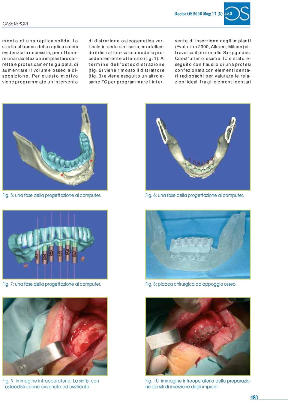 Per questo motivo viene programmato un intervento di distrazione osteogenetica verticale in sede sinfisaria, modellando il distrattore sul biomodello precedentemente ottenuto (fig. 1).