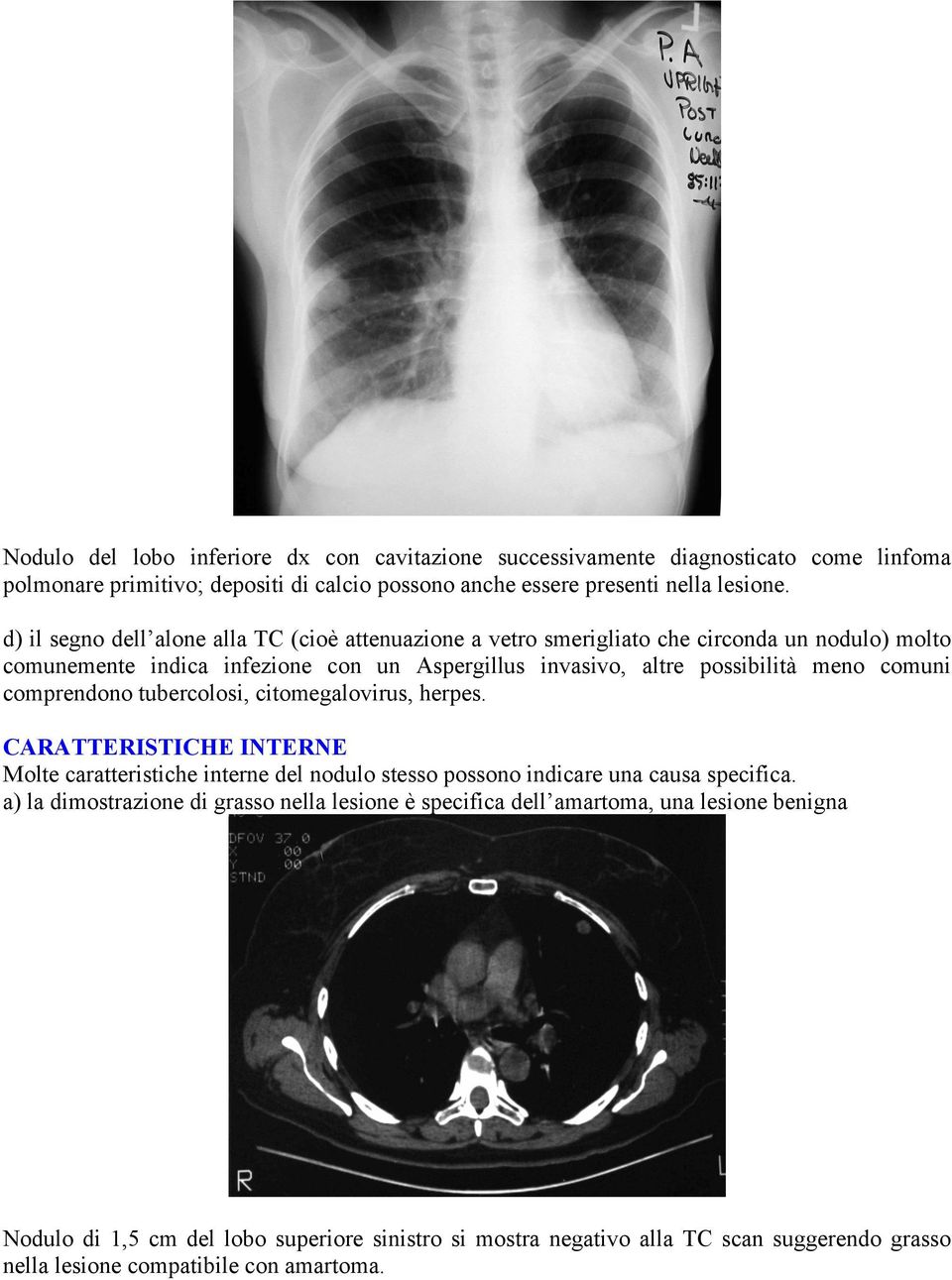 comuni comprendono tubercolosi, citomegalovirus, herpes. CARATTERISTICHE INTERNE Molte caratteristiche interne del nodulo stesso possono indicare una causa specifica.