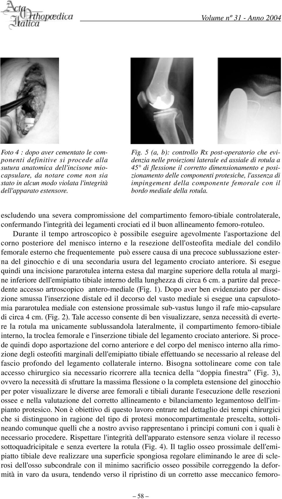 5 (a, b): controllo Rx post-operatorio che evidenzia nelle proiezioni laterale ed assiale di rotula a 45 di flessione il corretto dimensionamento e posizionamento delle componenti protesiche,