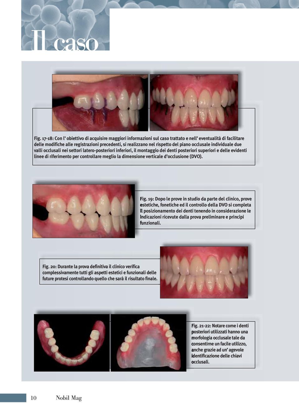 dimensione verticale d occlusione (DVO). Fig.