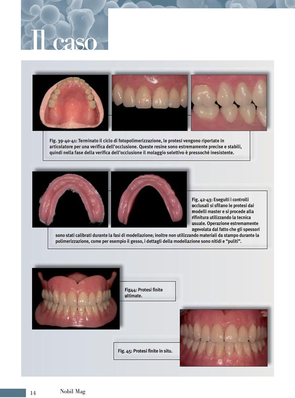 42-43: Eseguiti i controlli occlusali si sfilano le protesi dai modelli master e si procede alla rifinitura utilizzando la tecnica usuale.
