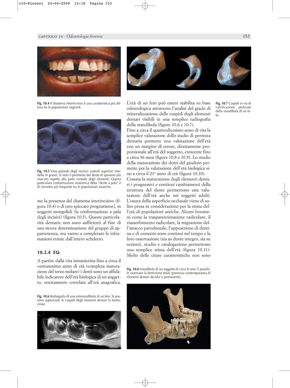 Questa particolare conformazione anatomica detta dente a pala è di riscontro più frequente tra le popolazioni asiatiche. me la presenza del diastema interincisivo (figura 10.
