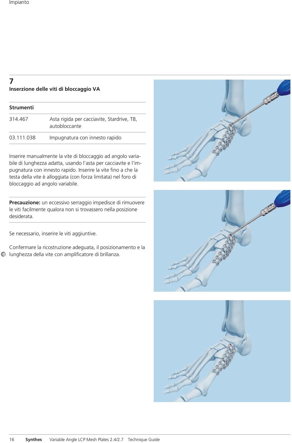 Inserire la vite fino a che la testa della vite è alloggiata (con forza limitata) nel foro di bloccaggio ad angolo variabile.