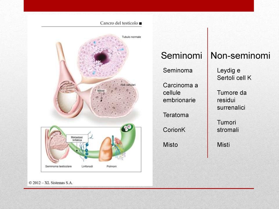 Misto Leydig e Sertoli cell K Tumore da