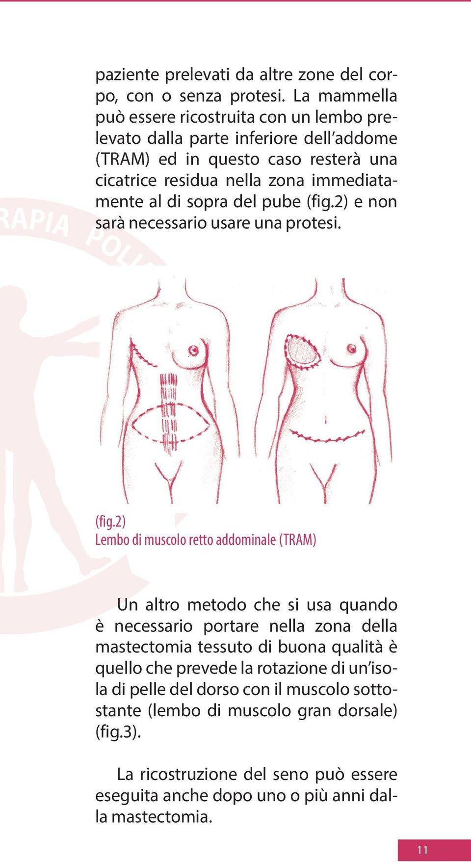 al di sopra del pube (fig.