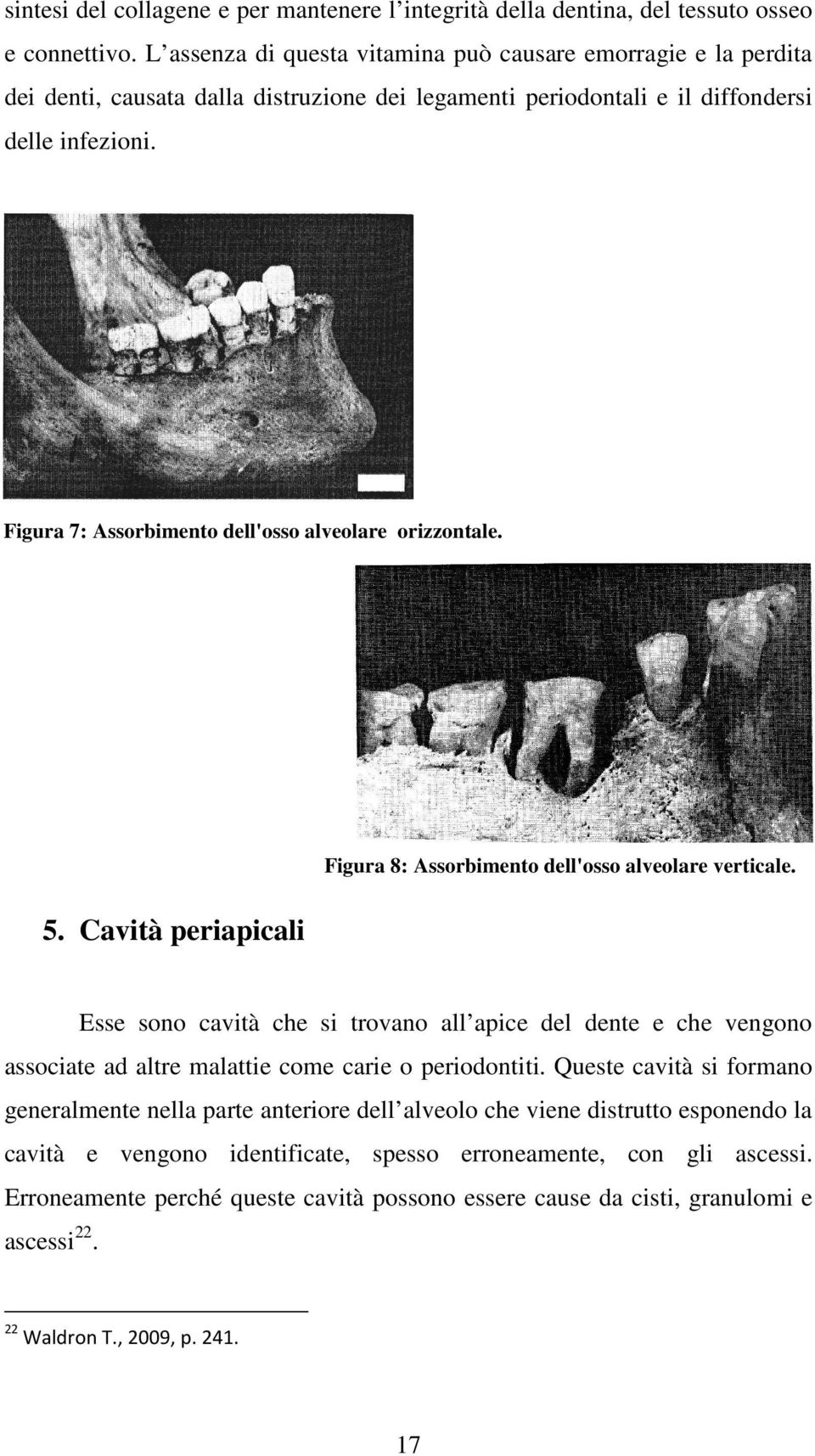 Figura 7: Assorbimento dell'osso alveolare orizzontale. 5. Cavità periapicali Figura 8: Assorbimento dell'osso alveolare verticale.