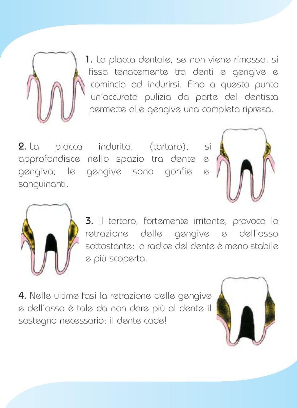 La placca indurita, (tartaro), si approfondisce nello spazio tra dente e gengiva; le gengive sono gonfie e sanguinanti. 3.
