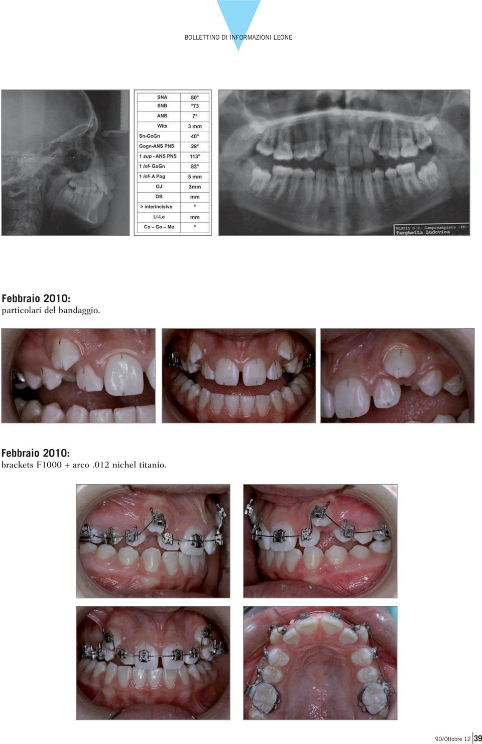 Febbraio 2010: brackets