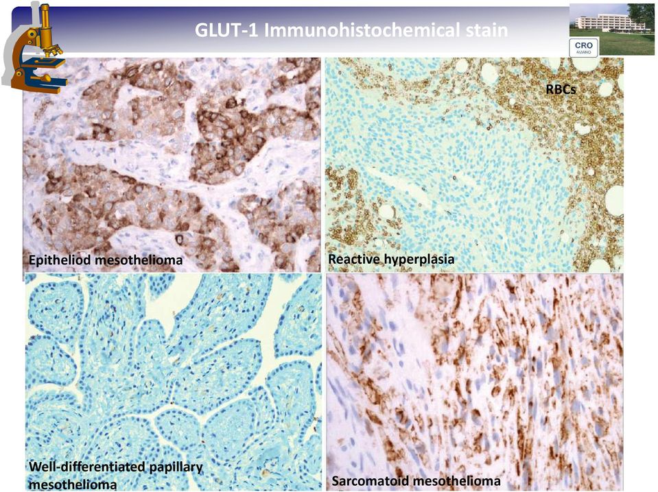 hyperplasia Well-differentiated