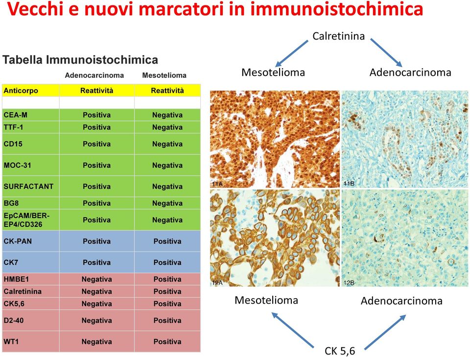 SURFACTANT Positiva Negativa BG8 Positiva Negativa EpCAM/BER- EP4/CD326 Positiva Negativa CK-PAN Positiva Positiva CK7 Positiva Positiva