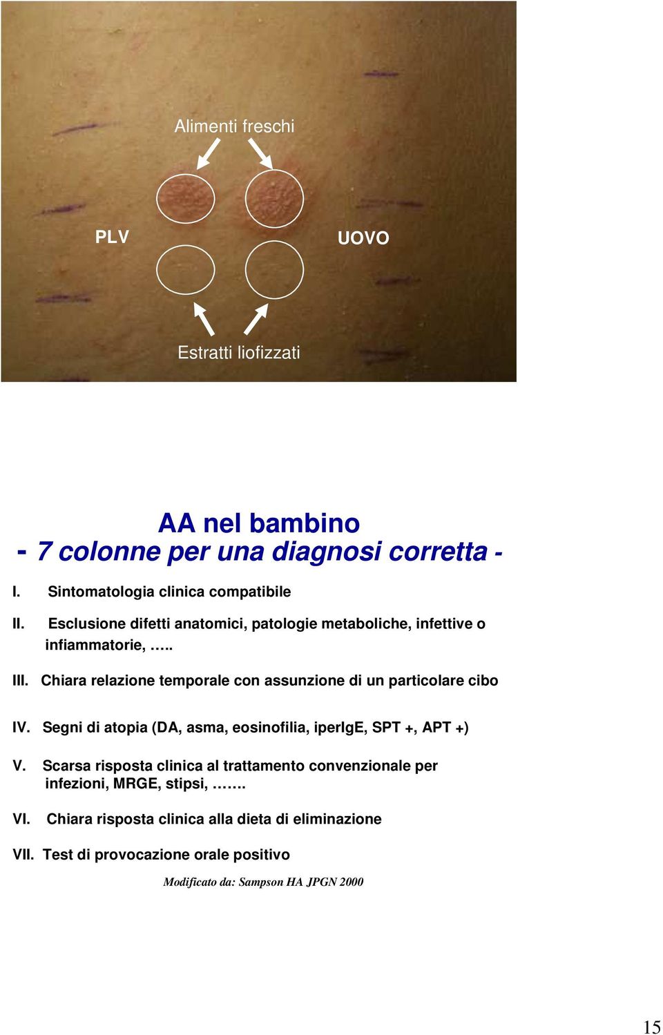 Chiara relazione temporale con assunzione di un particolare cibo IV. Segni di atopia (DA, asma, eosinofilia, iperige, SPT +, APT +) V.