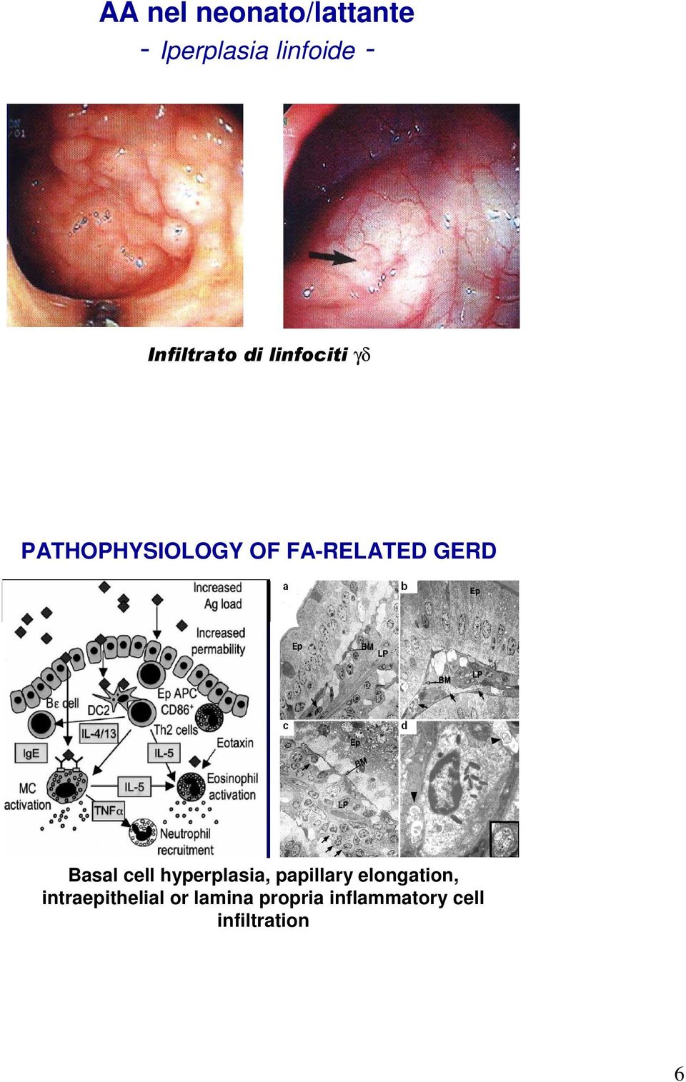 FA-RELATED GERD Basal cell hyperplasia, papillary