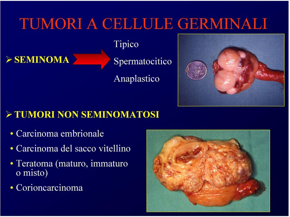 SEMINOMATOSI Carcinoma embrionale Carcinoma del