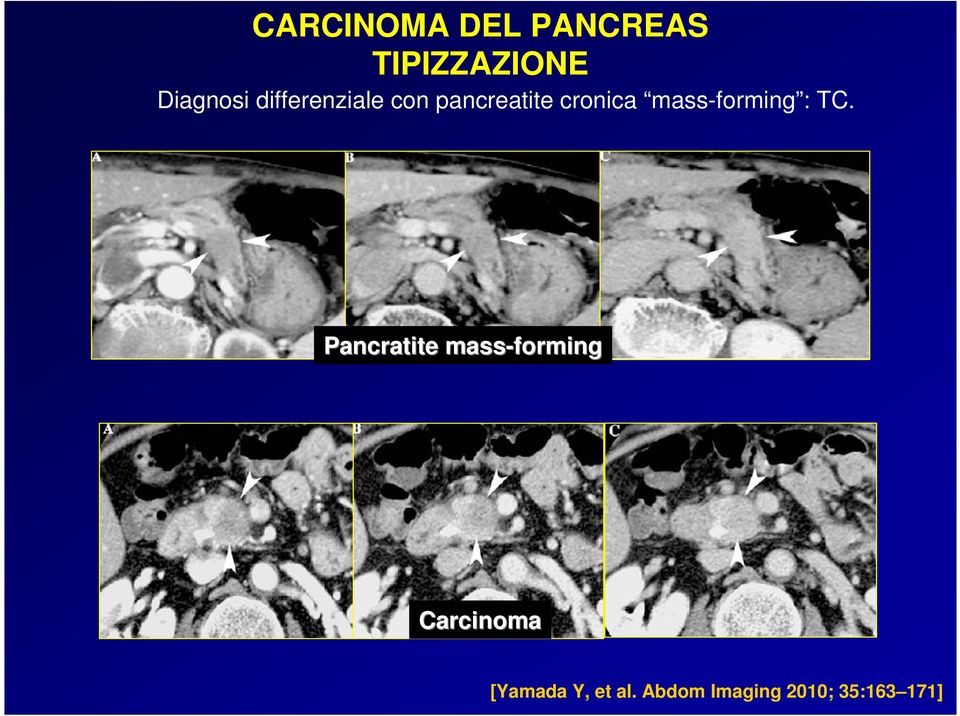 Pancratite mass-forming Carcinoma