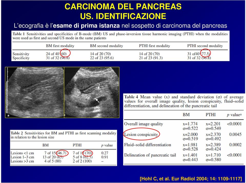 di carcinoma del pancreas [Hohl C,