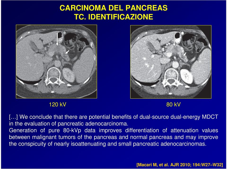 Generation of pure 80-kVp data improves differentiation of attenuation values between malignant tumors of the