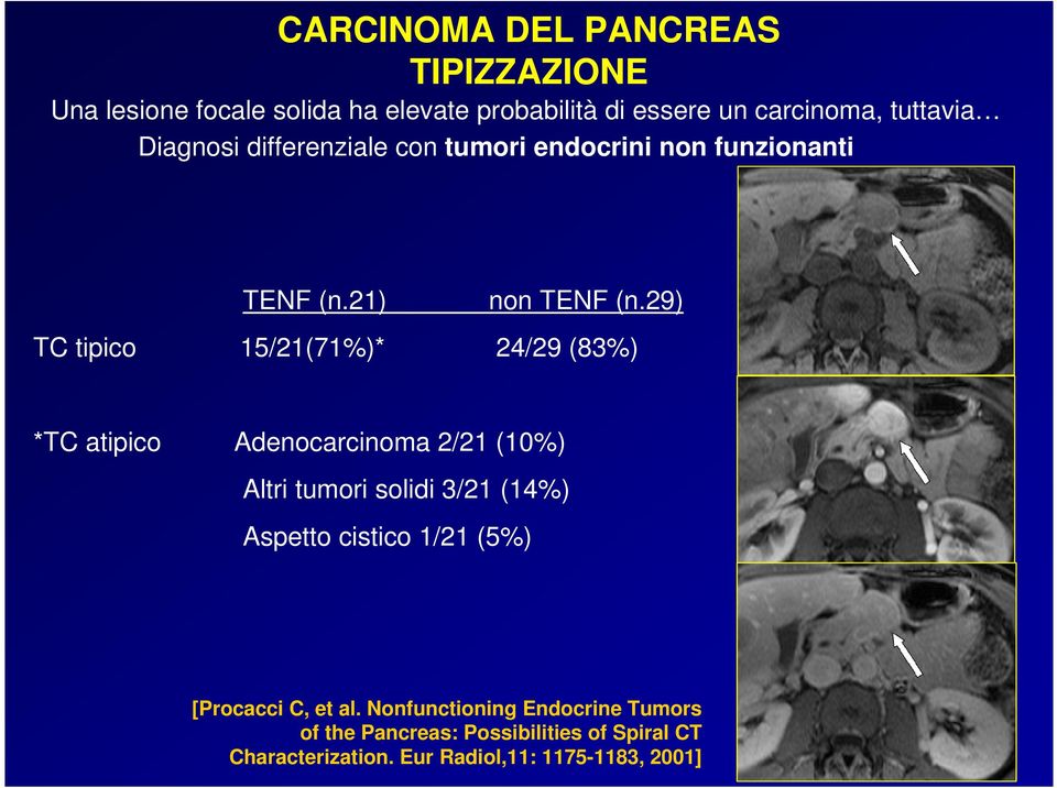 29) TC tipico 15/21(71%)* 24/29 (83%) *TC atipico Adenocarcinoma 2/21 (10%) Altri tumori solidi 3/21 (14%) Aspetto