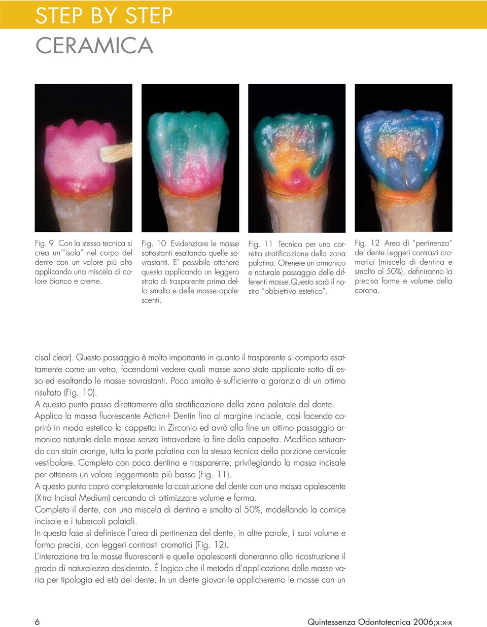 11 Tecnica per una corretta stratificazione della zona palatina. Ottenere un armonico e naturale passaggio delle differenti masse.questo sarà il nostro obbiettivo estetico. Fig.