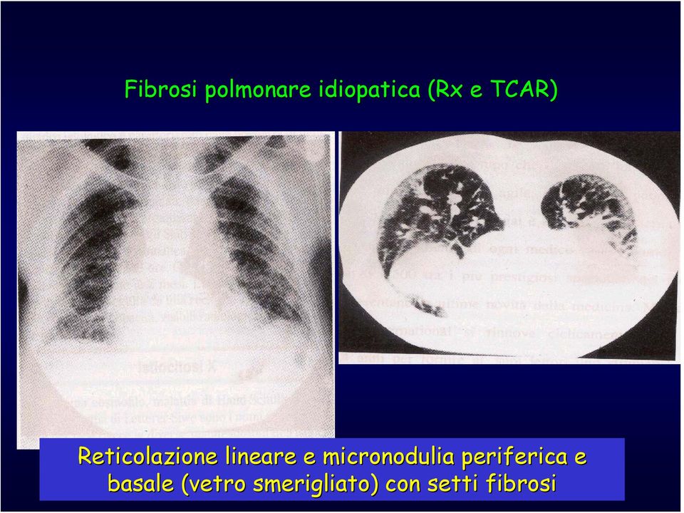 micronodulia periferica e basale