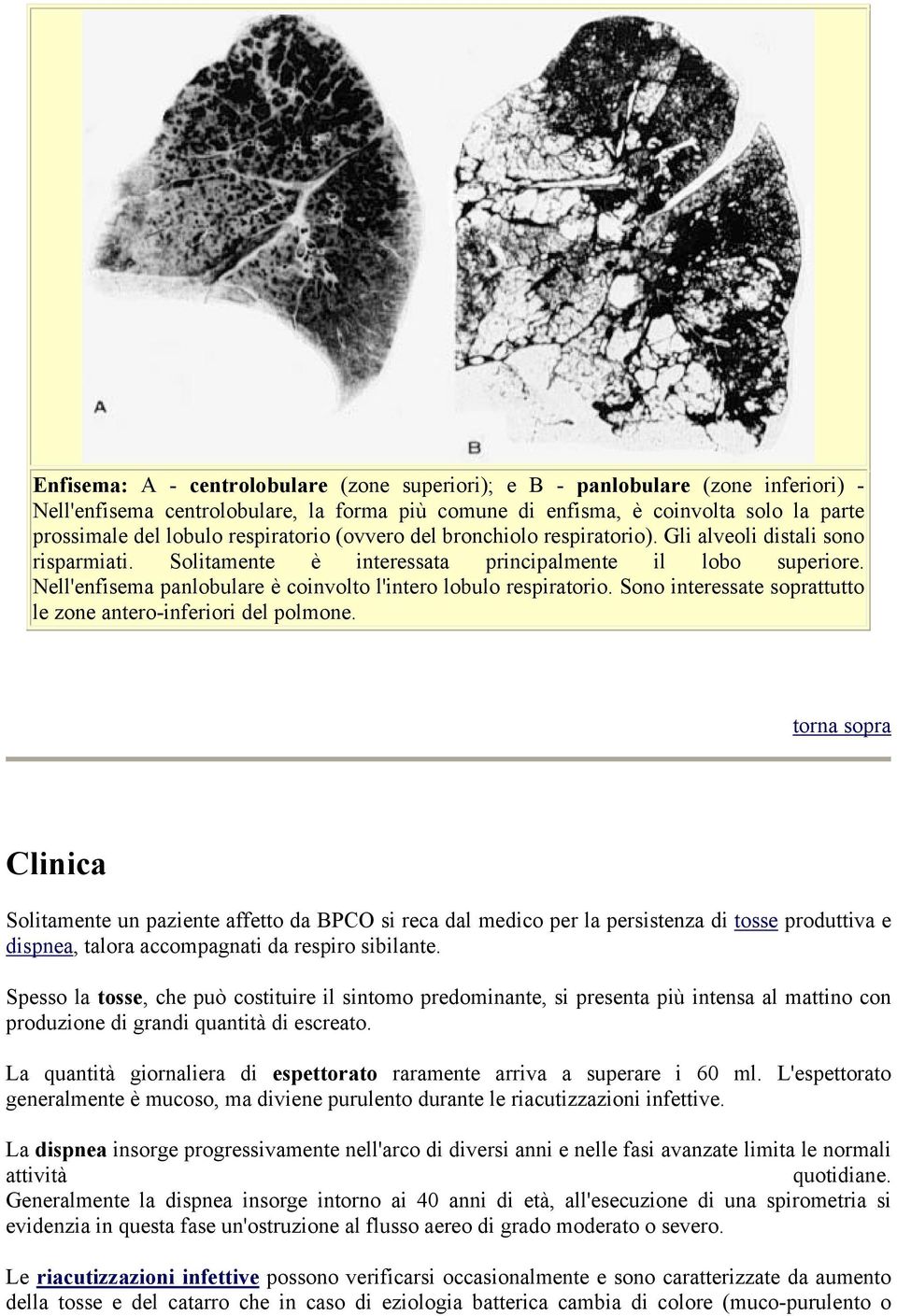 Nell'enfisema panlobulare è coinvolto l'intero lobulo respiratorio. Sono interessate soprattutto le zone antero-inferiori del polmone.