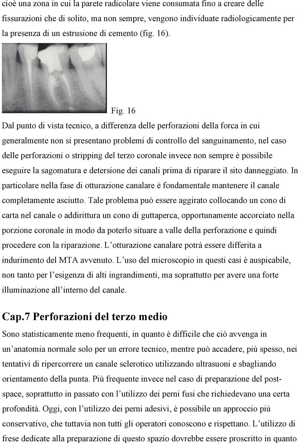 16 Dal punto di vista tecnico, a differenza delle perforazioni della forca in cui generalmente non si presentano problemi di controllo del sanguinamento, nel caso delle perforazioni o stripping del