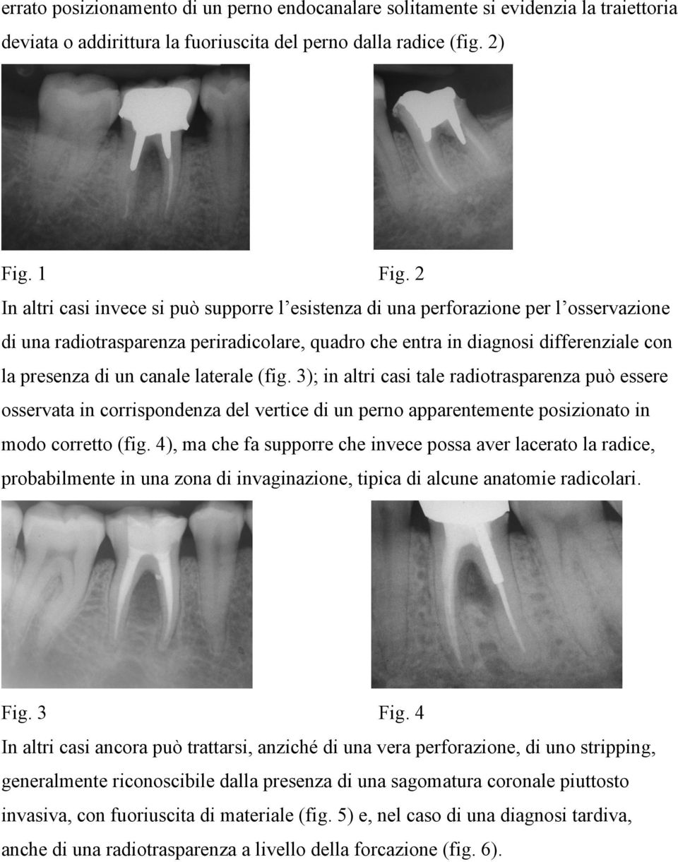 canale laterale (fig. 3); in altri casi tale radiotrasparenza può essere osservata in corrispondenza del vertice di un perno apparentemente posizionato in modo corretto (fig.