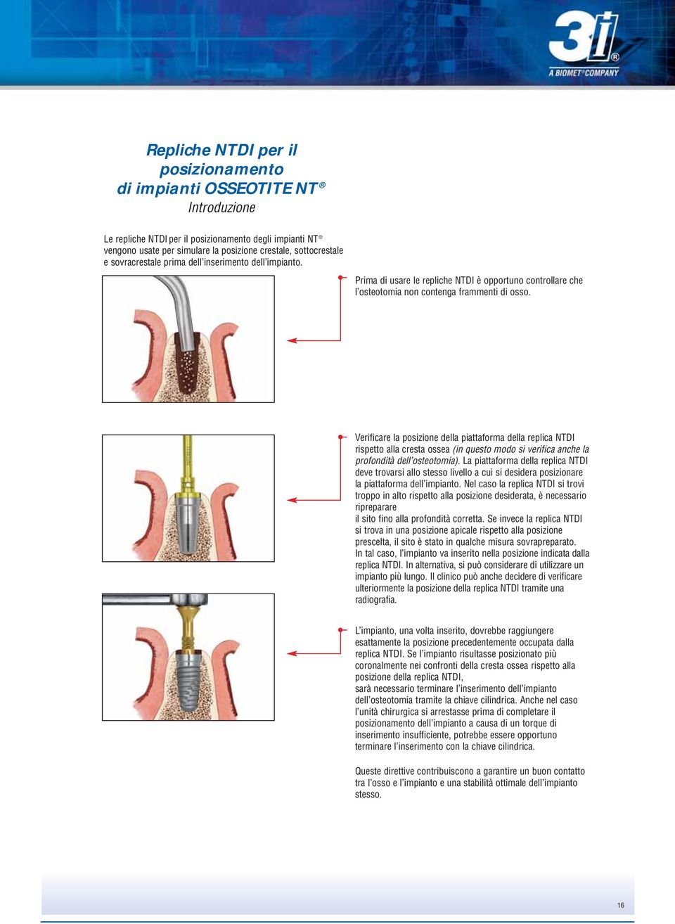 Verificare la posizione della piattaforma della replica NTDI rispetto alla cresta ossea (in questo modo si verifica anche la profondità dell osteotomia).