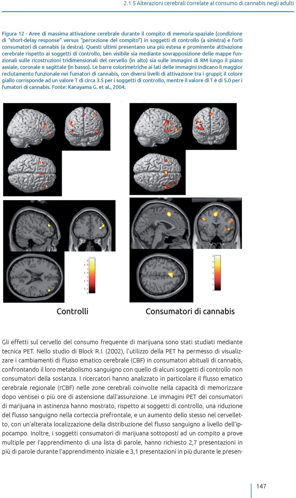 Questi ultimi presentano una più estesa e prominente attivazione cerebrale rispetto ai soggetti di controllo, ben visibile sia mediante sovrapposizione delle mappe funzionali sulle ricostruzioni