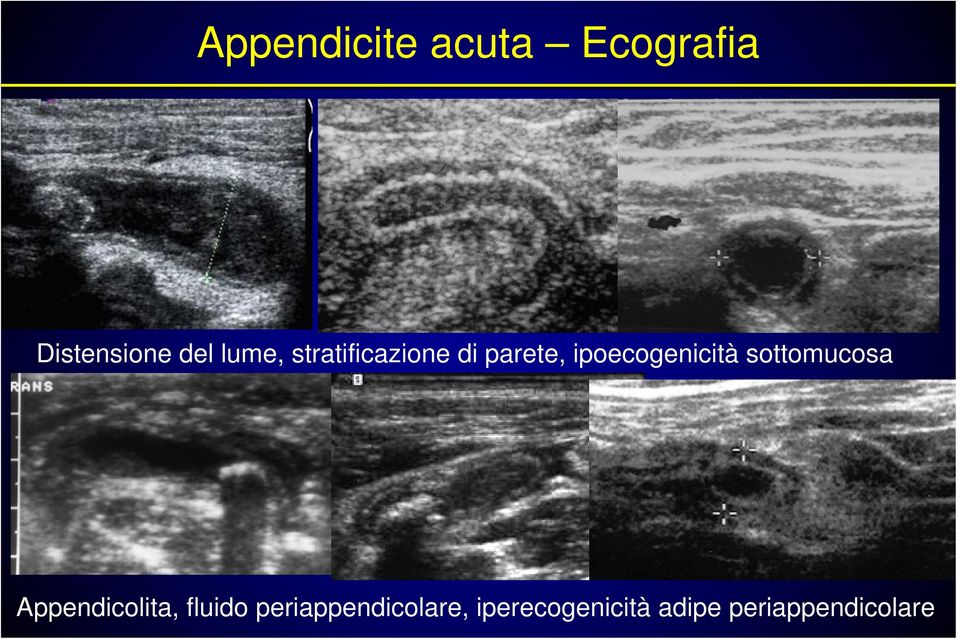 ipoecogenicità sottomucosa Appendicolita,