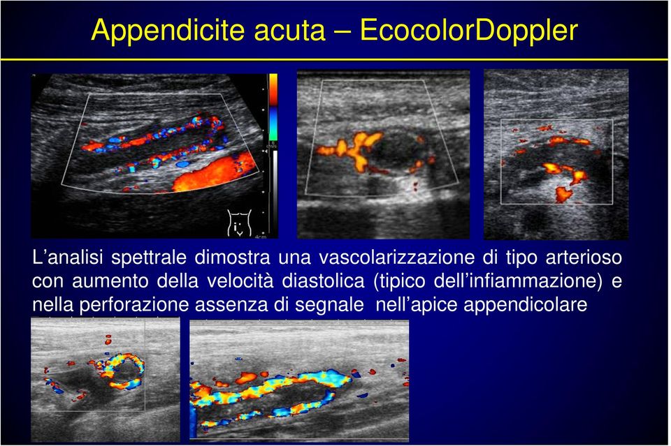 aumento della velocità diastolica (tipico dell