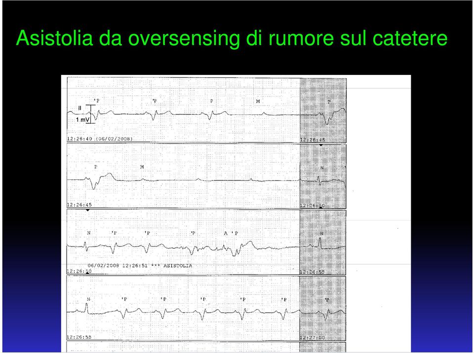 oversensing