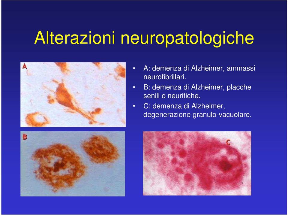 B: demenza di Alzheimer, placche senili o