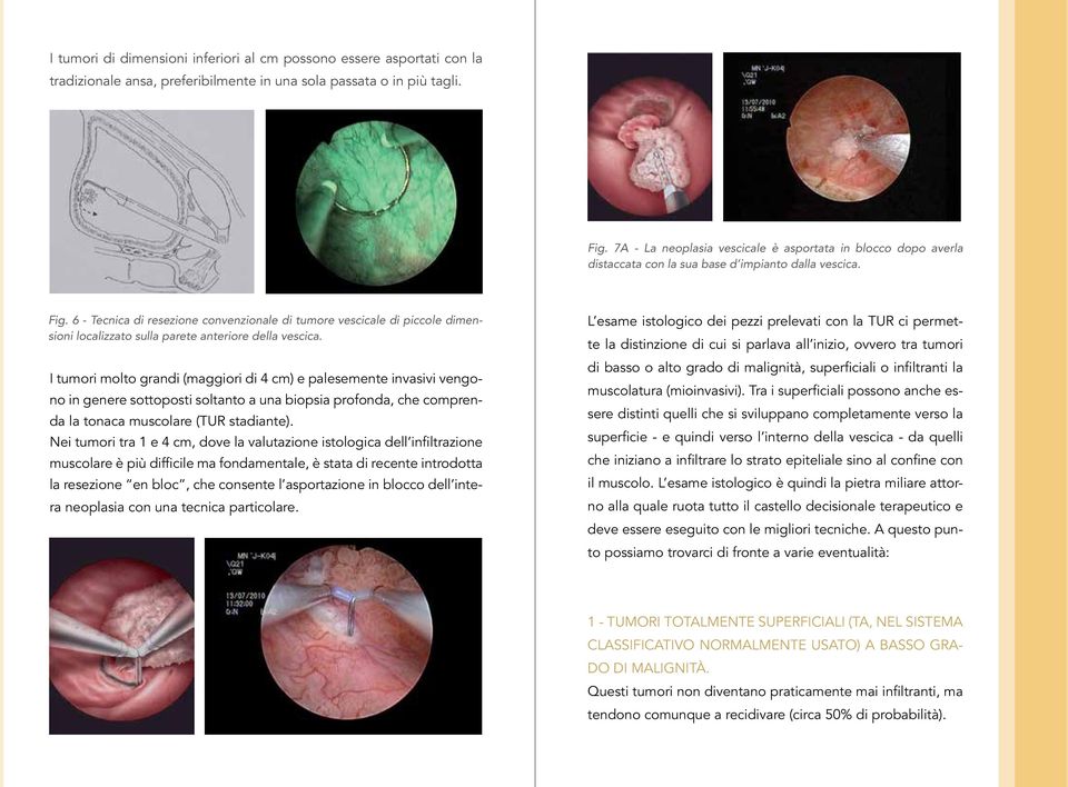 6 - Tecnica di resezione convenzionale di tumore vescicale di piccole dimensioni localizzato sulla parete anteriore della vescica.