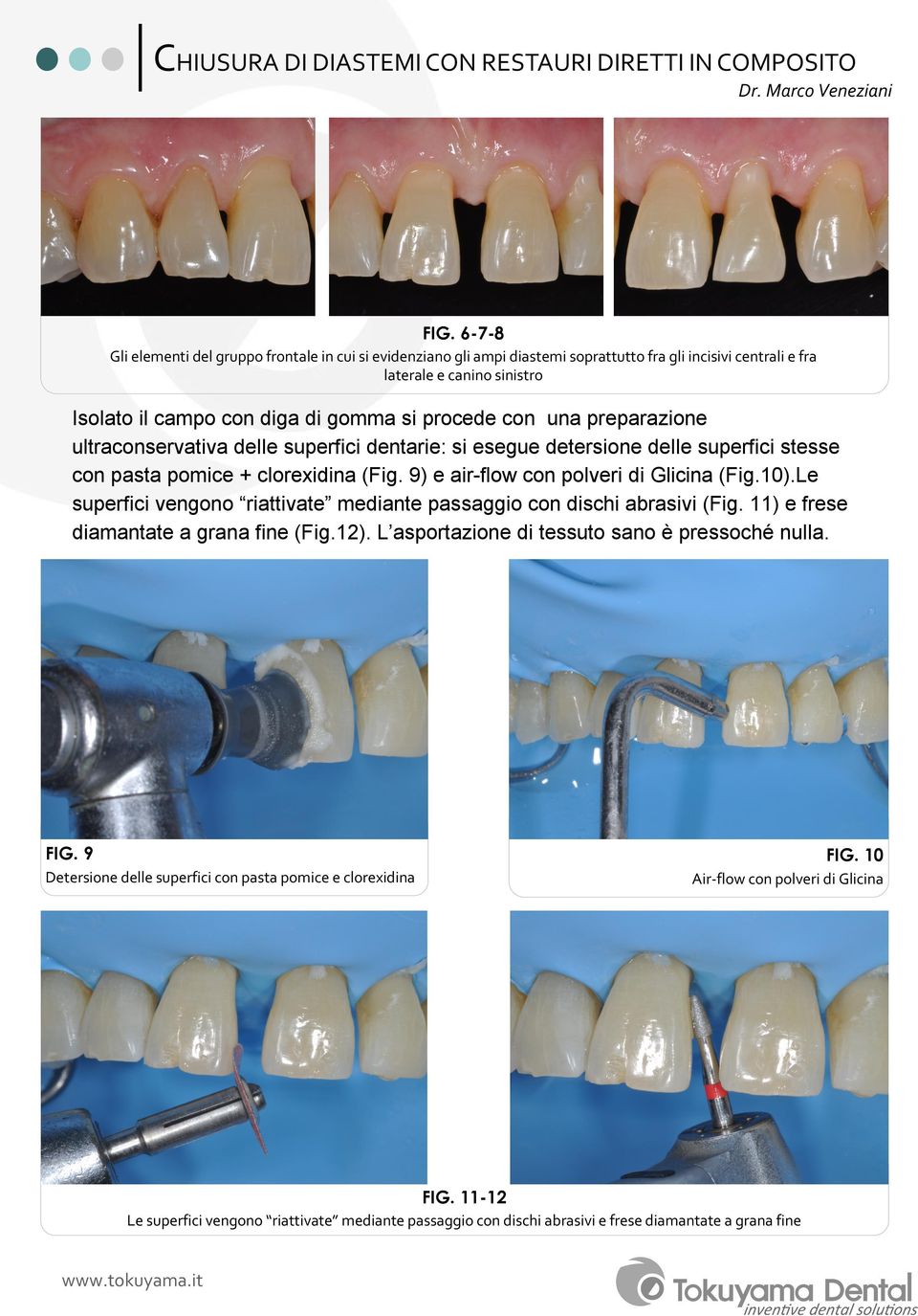 una preparazione ultraconservativa delle superfici dentarie: si esegue detersione delle superfici stesse con pasta pomice + clorexidina (Fig. 9) e air-flow con polveri di Glicina (Fig.10).