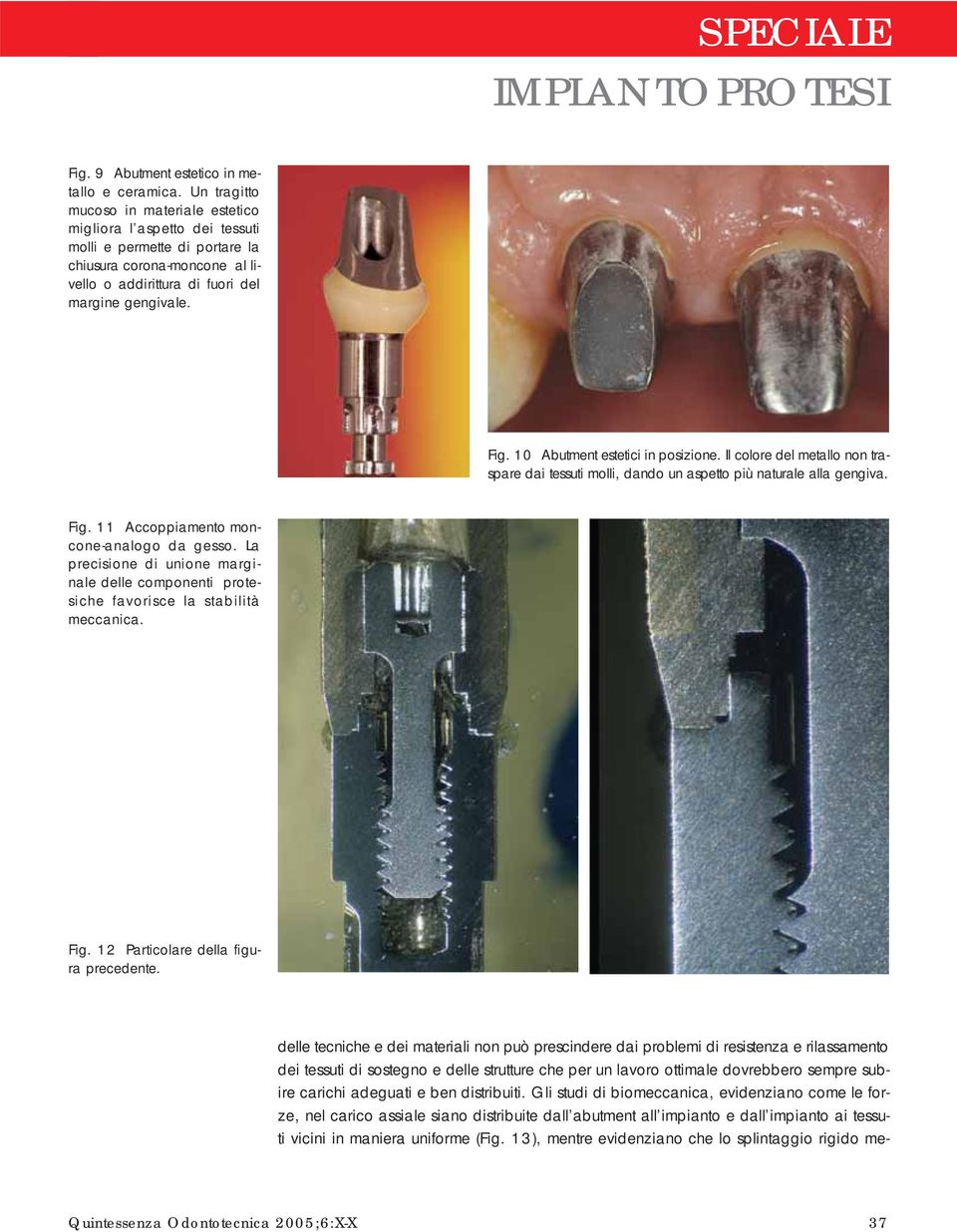 10 Abutment estetici in posizione. Il colore del metallo non traspare dai tessuti molli, dando un aspetto più naturale alla gengiva. Fig. 11 Accoppiamento moncone-analogo da gesso.