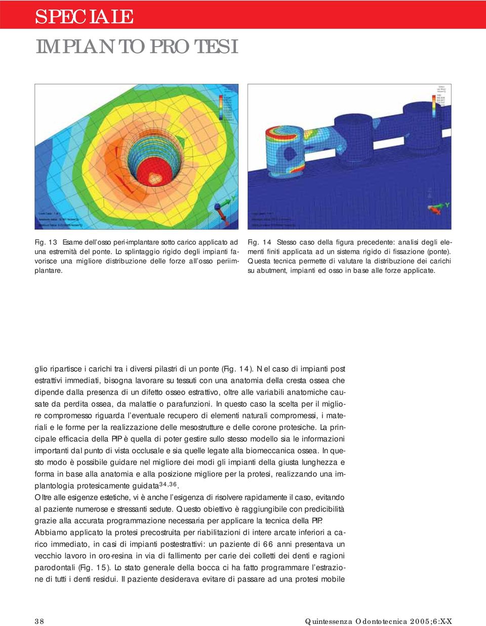 14 Stesso caso della figura precedente: analisi degli elementi finiti applicata ad un sistema rigido di fissazione (ponte).