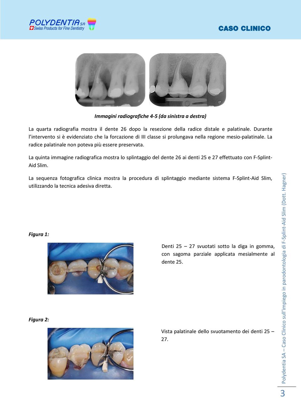 La quinta immagine radiografica mostra lo splintaggio del dente 26 ai denti 25 e 27 effettuato con F-Splint- Aid Slim.