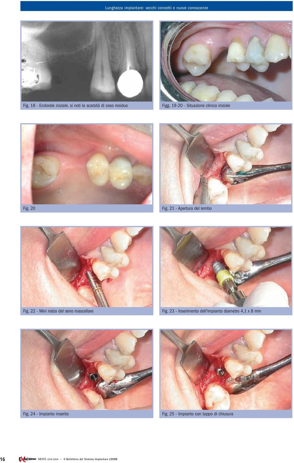 20 Fig. 21 - Apertura del lembo Fig. 22 - Mini rialzo del seno mascellare Fig.