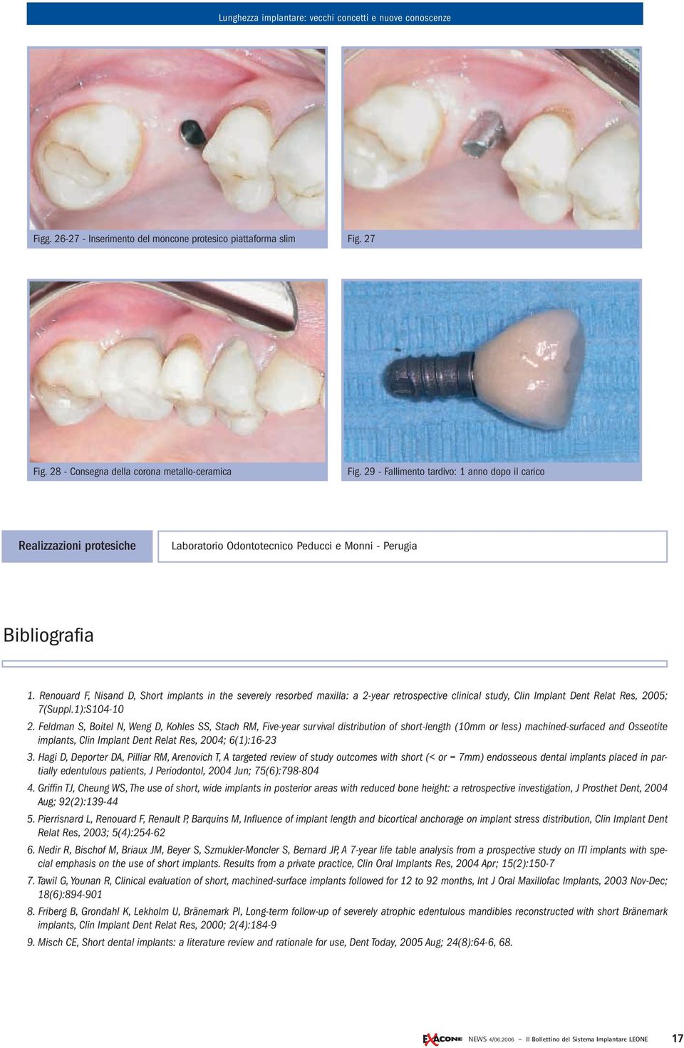 Renouard F, Nisand D, Short implants in the severely resorbed maxilla: a 2-year retrospective clinical study, Clin Implant Dent Relat Res, 2005; 7(Suppl.1):S104-10 2.