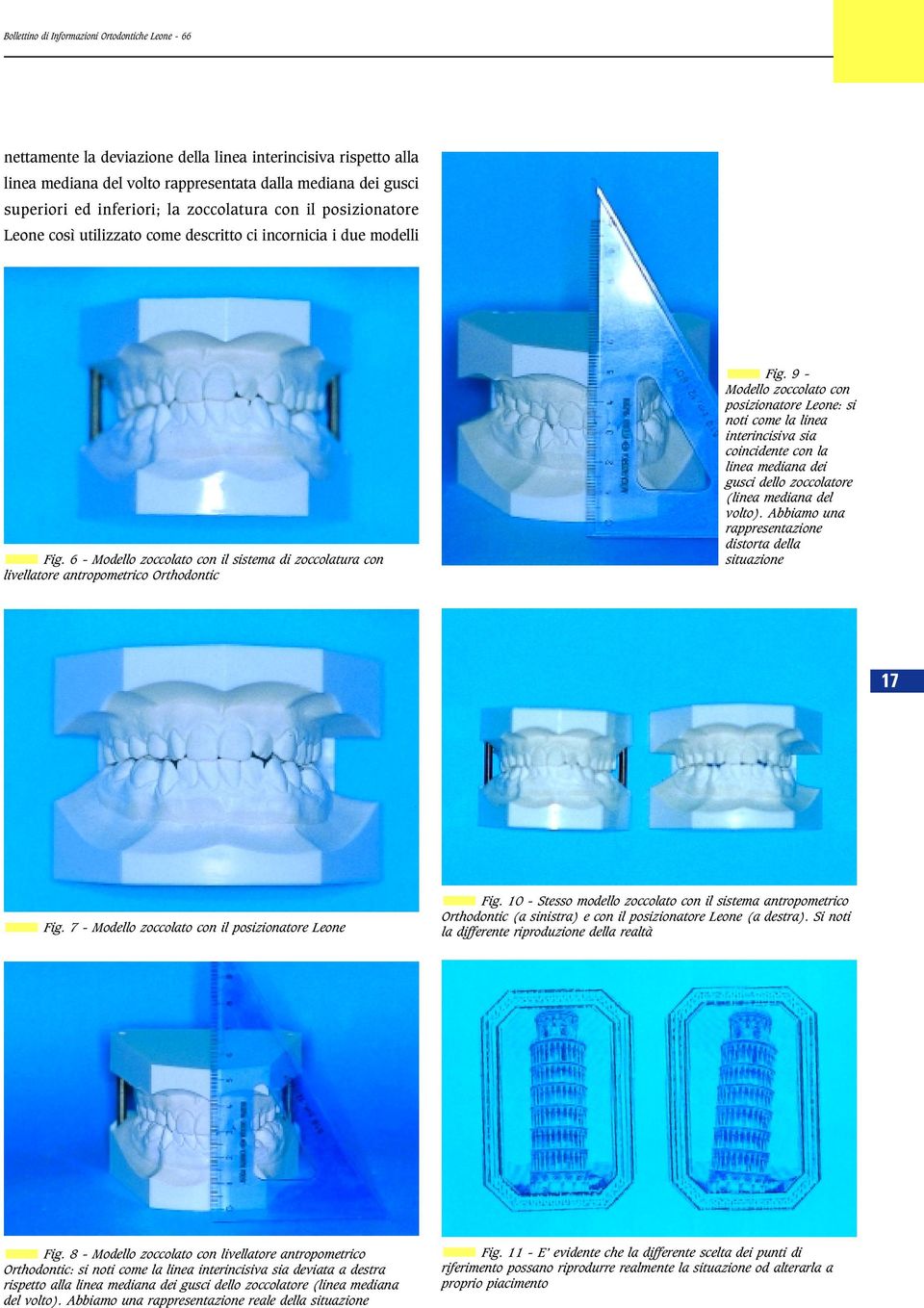9 - Modello zoccolato con posizionatore Leone: si noti come la linea interincisiva sia coincidente con la linea mediana dei gusci dello zoccolatore (linea mediana del volto).