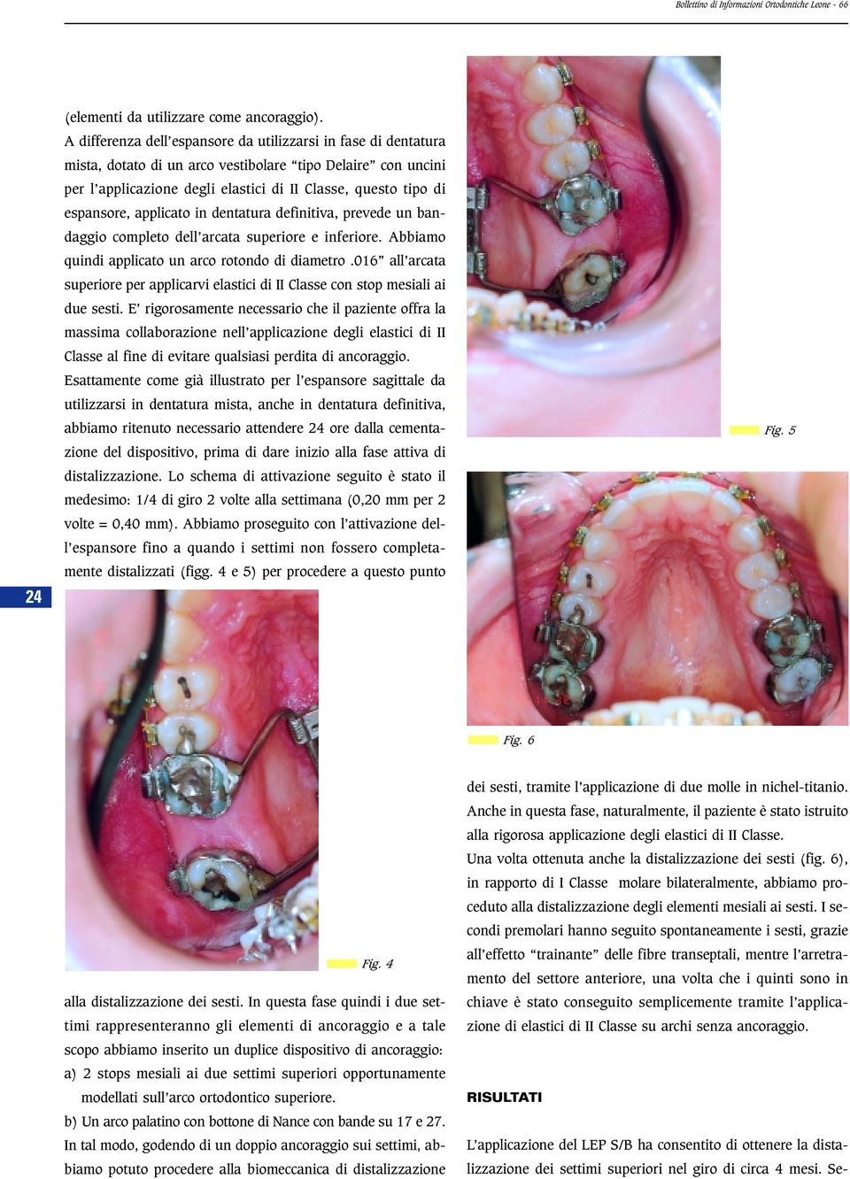 applicato in dentatura definitiva, prevede un bandaggio completo dell arcata superiore e inferiore. Abbiamo quindi applicato un arco rotondo di diametro.