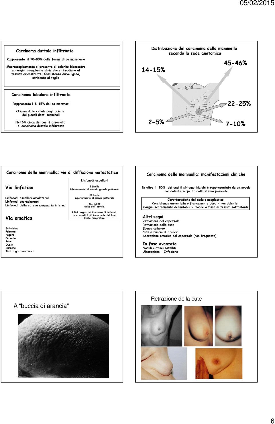 Consistenza duro-lignea, stridente al taglio Distribuzione del carcinoma della mammella secondo la sede anatomica 14-15% 45-46% Carcinoma lobulare infiltrante Rappresenta l 8-15% dei ca mammari