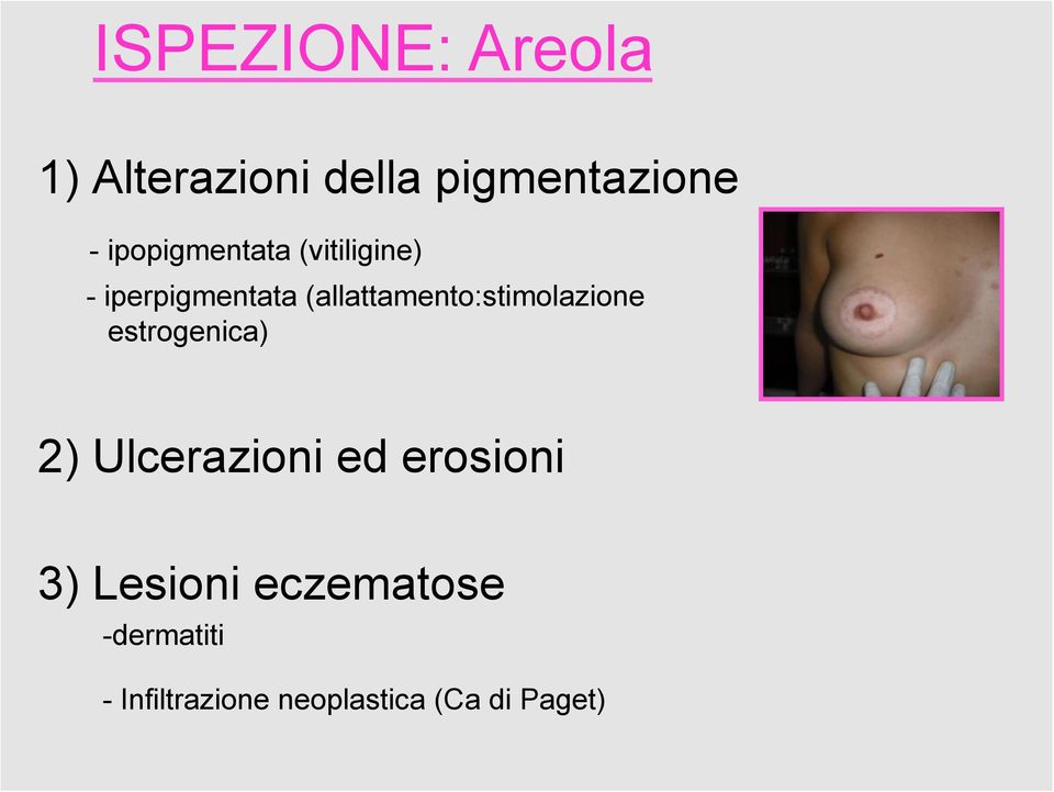 (allattamento:stimolazione estrogenica) 2) Ulcerazioni ed